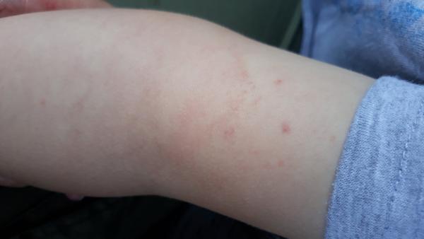 Problémy u 2letého synka. Ekzém či alergie?