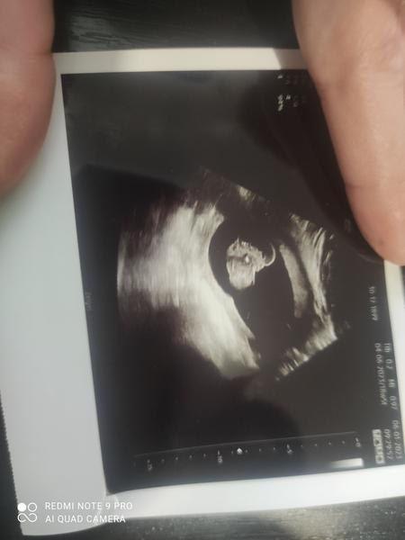 Je to holka nebo kluk? Nejistota po vyšetření ultrazvukem.