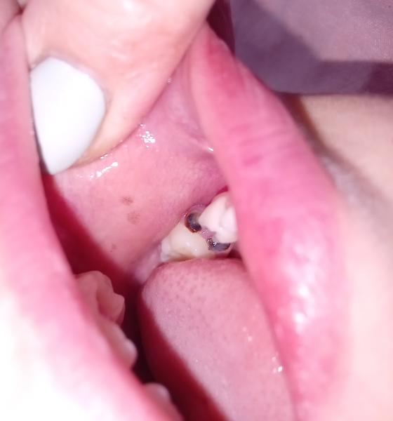 Hnědé fleky na dásni u dítěte. Poradíte?