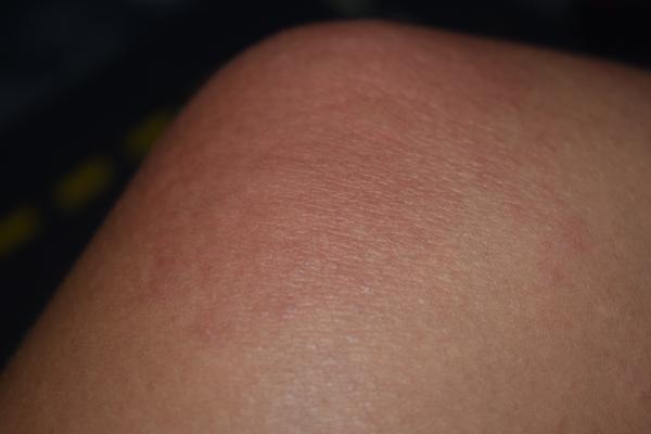 Co způsobuje svědění a vyrážku na kloubech?