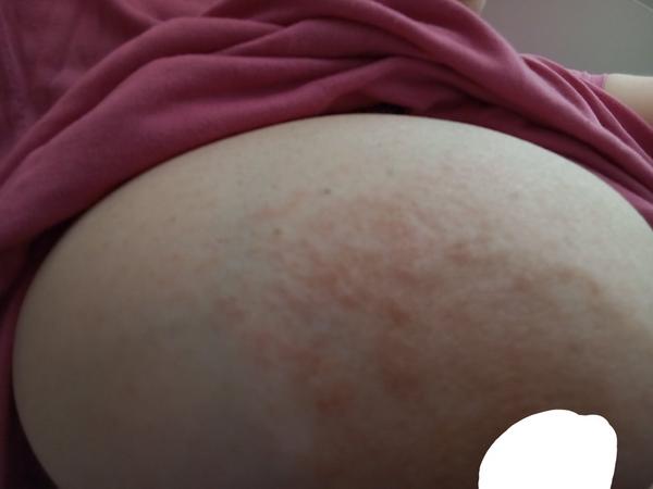 Co pomůže na zarudlé bradavky?