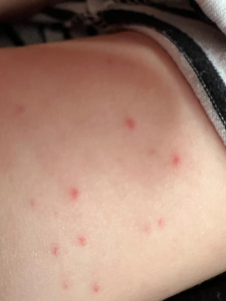 Pupínky u tříletého. Co by to mohlo být?