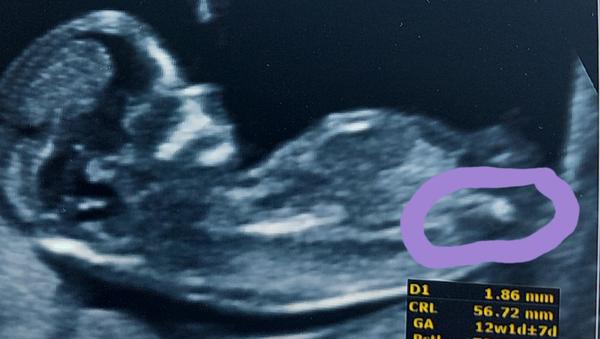 Holčička nebo chlapeček? Výsledky screeningu a tip lékaře.