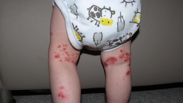 Zhoršení exému po očkování proti spalničkám