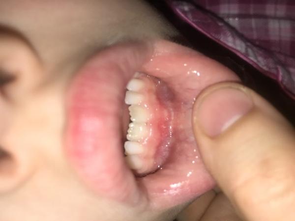 Tvrdý útvar u kořene nového zubu. Máte zkušenost?