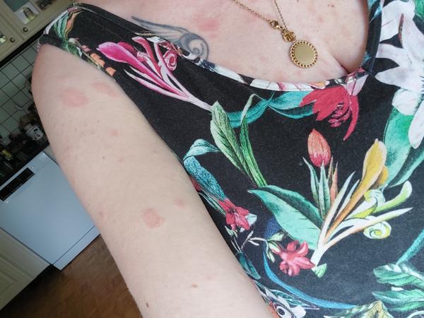 Je to pityriasis rosea? Zkušenosti a léčba této vyrážky.