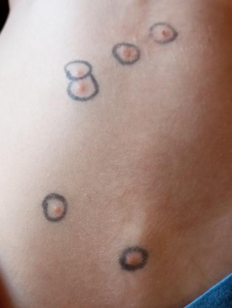 Jak správně léčit neštovice doma?