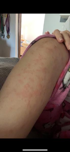 Fleky na noze. Co by to mohlo být?