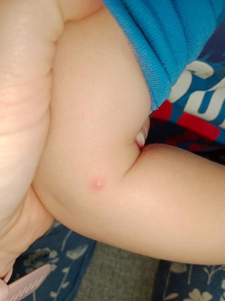 Pupínky. Je možné, že jsou to neštovice?