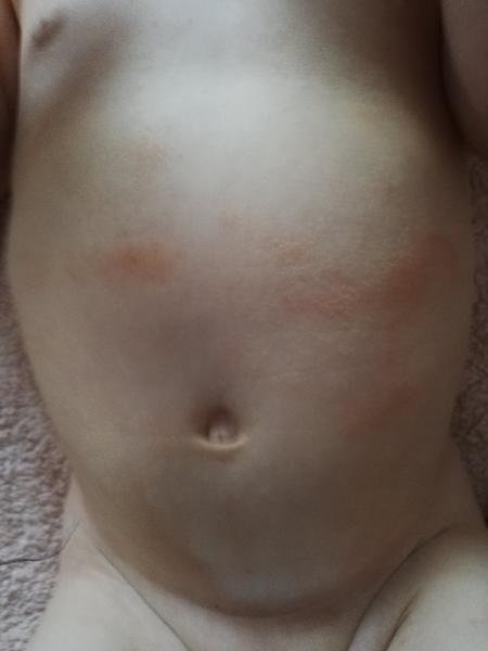 Zřejmě ekzém. Poradíte, prosím?