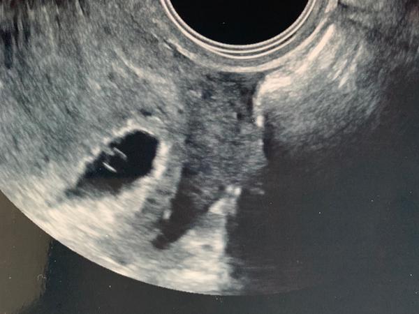 Ultrazvuk 5+5. tt. Přijde vám v pohodě?