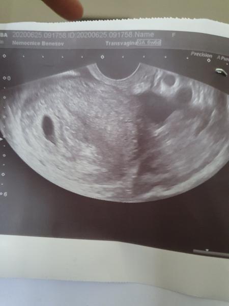 První ultrazvuk. Co na to říkáte?