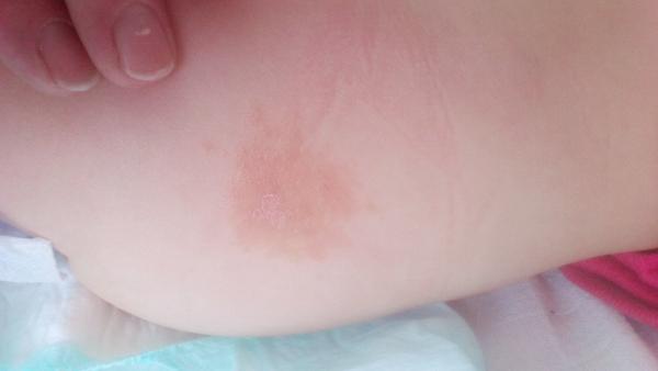 Ekzém? Čím mazat?