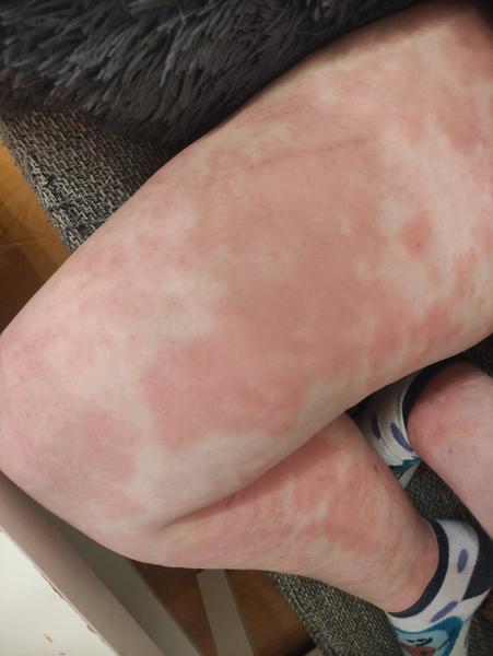 Atopický ekzém. Poradíte, prosím?