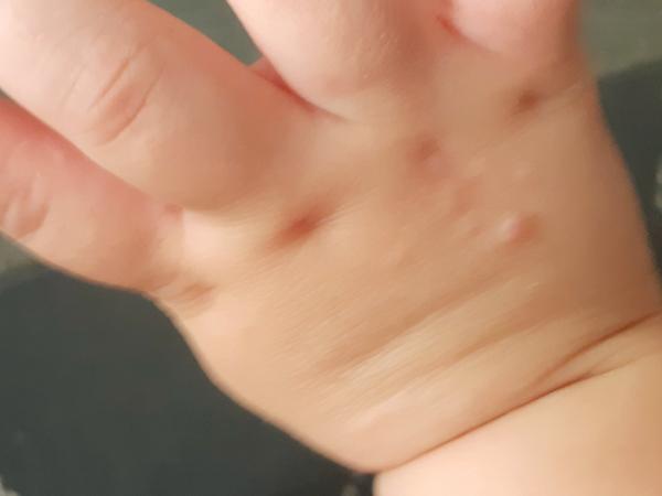 Co může být příčinou vyrážky s rýmou u dítěte?