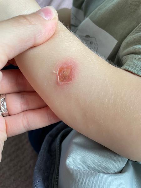 Za jak dlouho pomůže Framykoin při impetigu u dětí?