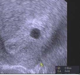 Foto z UTZ v 5. týdnu. Máte někdo?