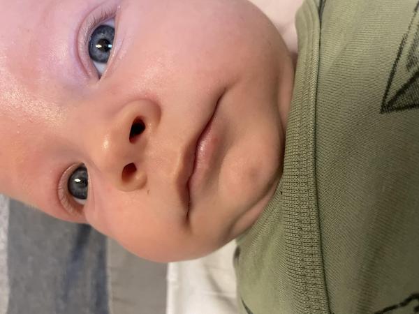 Opar u novorozence. Je nutná návštěva lékaře?