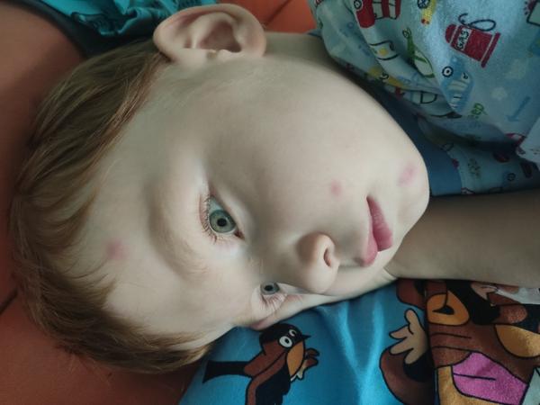 Alergie. Může to být horší? Kdy fleky zmizí?