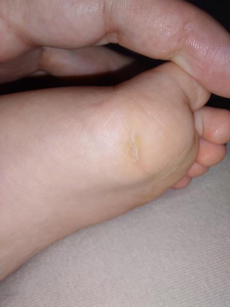 Čím účinně promazávat mozoly na dětských chodidlech?