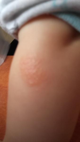 Suché červené flíčky, co to může být?