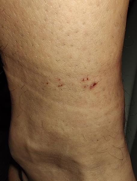 Strupovitá svědivá vyrážka na nohách: svrab nebo kočičí blechy?