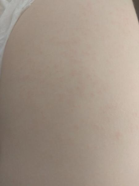 Vyrážka - krupička u dvouletého syna