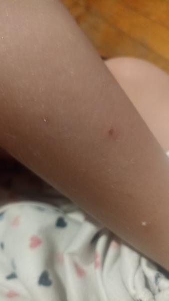 Rozpoznání vyrážky u dětí: Neštovice nebo štípnutí hmyzem?