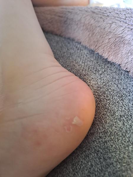 Puchýřky na nohou po sedmé nemoci: Co dělat?