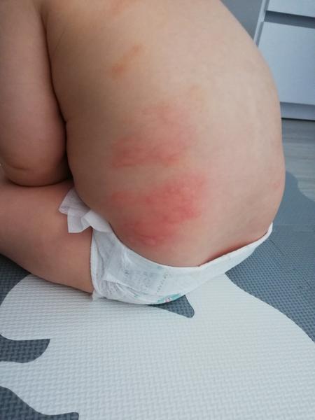 Alergie u dětí: Příznaky a řešení zkušeností rodičů