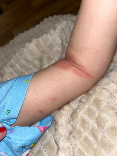 Locoid na atopický ekzém. Je to správné řešení?