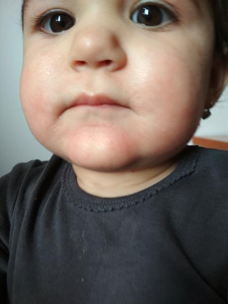 Trvající zarudnutí okolo úst u roční dcery. Prosím, poradíte?