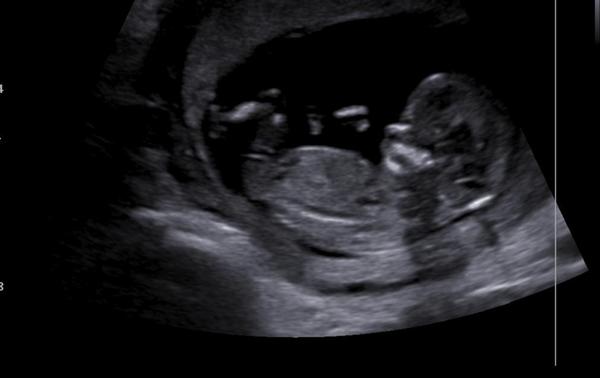 Holčička nebo chlapeček? Jde to poznat?