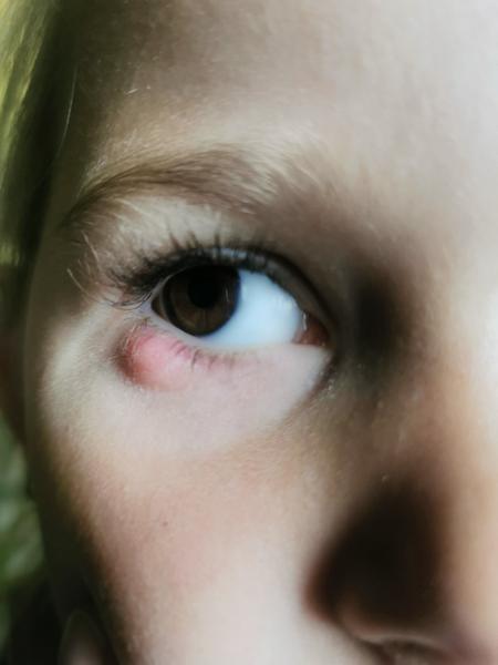 Jak léčit ječné zrno u dětí. Alternativní metody a tipy.