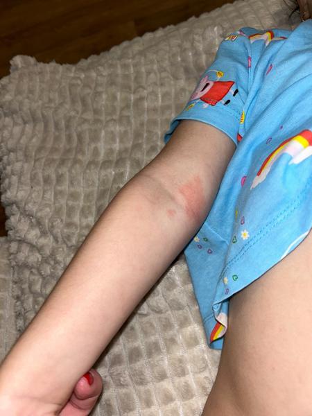 Locoid na atopický ekzém. Je to správné řešení?