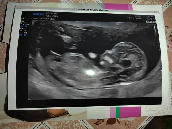 Jak určit pohlaví podle hrbolku ve 14. týdnu?