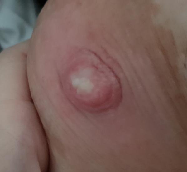 Příšerné bolesti bradavky. Můžete mi prosím poradit?