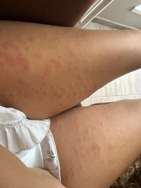 Co dělat, když vás trápí neznámá vyrážka?