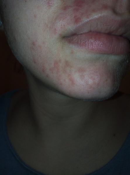 Vyrážka (ekzém) kolem pusy. Můžete mi prosím poradit?