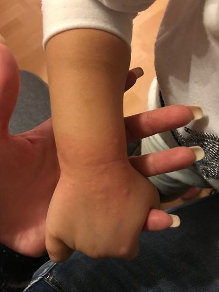 Vyrážka jen na pár hodin u 3leté dcery