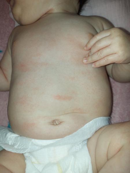 Co pomáhá na vyrážku a atopický ekzém u kojenců?