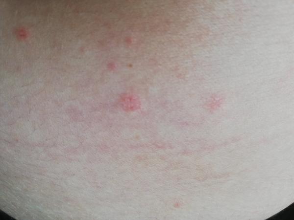 Neštovice podruhé ve 30 letech. Mohly by to být?