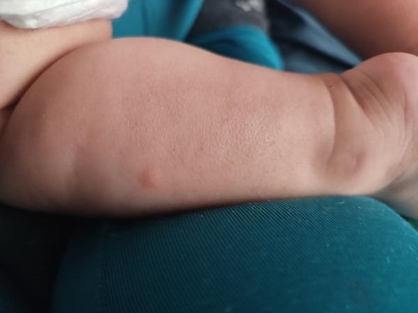 Vyrážka. Co by to mohlo být?