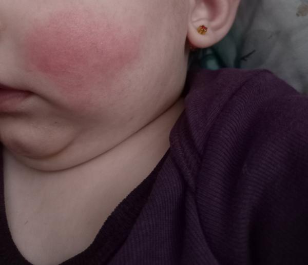 Jak řešit červené fleky na tváři u kojenců?