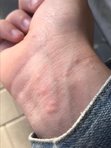 Svědivá kožní vyrážka: Co může být příčinou?