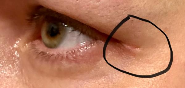 Jizva po operaci očních víček. Co s tím?