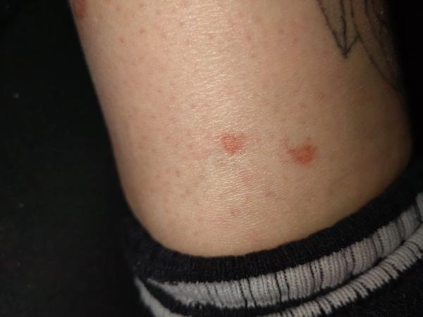 Vyrážka bez svědění. Co to může být?