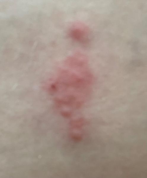 Jsou svědivé štípance na noze od štěnic?