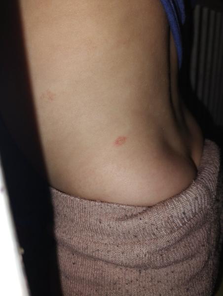 Suché zarudlé flíčky u dětí. Co je příčinou?