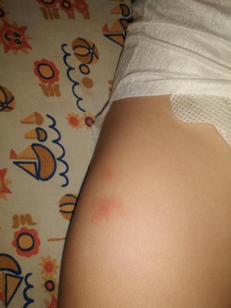 Prosím o radu. Mohou to být štípance?